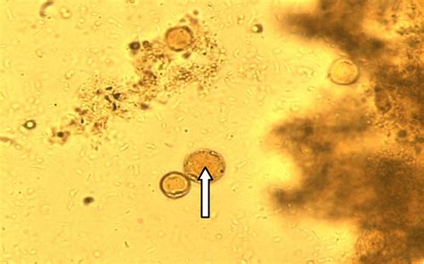 Quel traitement contre Blastocystis Hominis ? - Maladies infectieuses