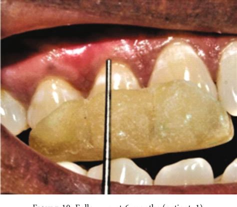 Figure From Marine Collagen Matrix Carrier With Injectable Platelet