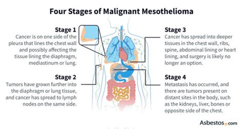 Mesothelioma Staging What Are The 4 Stages Of Mesothelioma