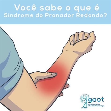 Você Sabe O Que é Sindrome Do Pronador Redondo Gaot