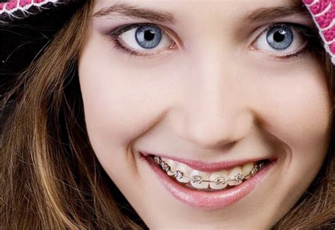 Qué alimentos debemos evitar cuando llevamos brackets Dentistas