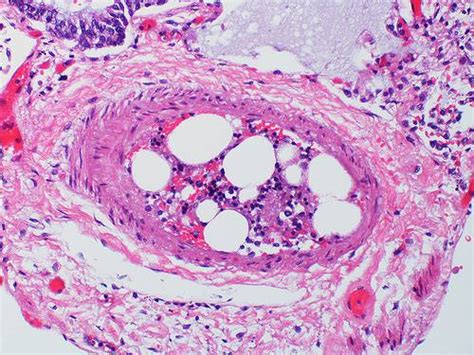 What Is the Survival Rate for Bone Marrow Cancer? - IYTmed.com