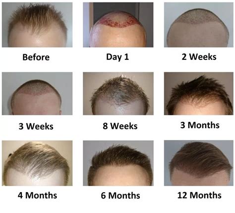 What Is The 3 Month Progress After A Hair Transplant Hair Sure