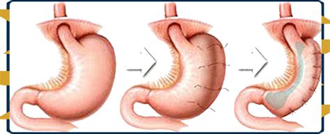 Gastric-Bypass-Complications - Dr.Amit Garg