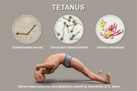 Tetanus-Syndrom Opisthotonus Bei Einem Menschen, Der an Tetanus Leidet ...