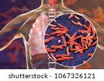 Tuberculosis Free Stock Photo - Public Domain Pictures