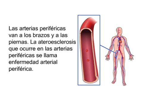 PatEdu Enfermedad arterial periférica EAP