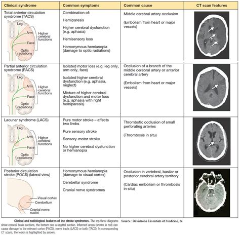 Stroke Location on CT - Emergency Medicine Kenya Foundation