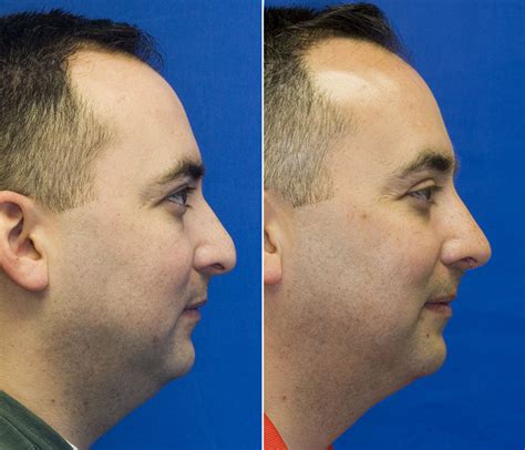 Ethnic Rhinoplasty Seattle Facial Plastic Surgeon Dr Lamperti