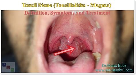 Tonsil Stone - Definition, Symptoms and Treatment