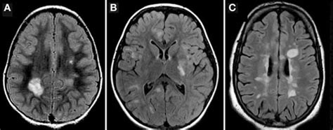 Understanding MS in children - Multiple Sclerosis (MS) Information, and resources