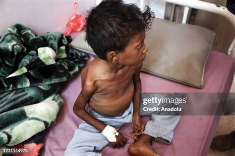 Hunger And Malnutrition Photos And Premium High Res Pictures Getty Images