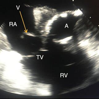 Transesophageal echocardiogram (TEE) TEE showing vegetation. (A =... | Download Scientific Diagram