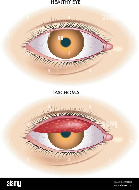 Lillustration Médicale Montre La Comparaison Entre Un œil Normal Et Un