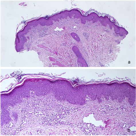 Papulosquamous Annular Diseases Clinics In Dermatology