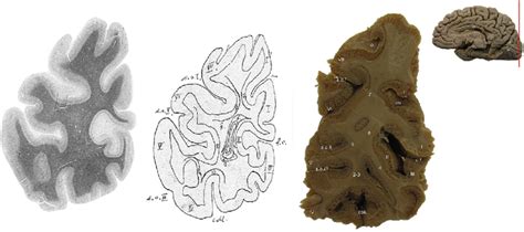 e Coronal section through the posterior portion of the cuneus (upper ...