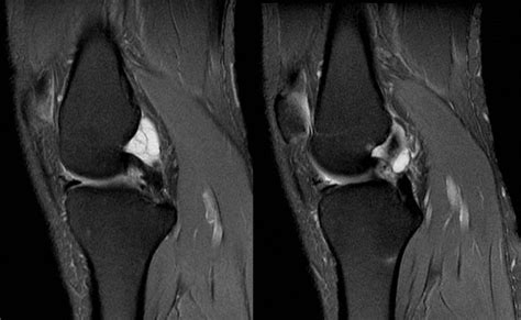 Radshare: GANGLION CYST OF KNEE