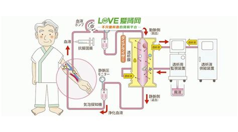 透析30年的成功秘笈！一定要注意这几点 知乎