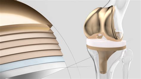 Advanced Surface Technology Innovative Multilayer Coating For Knee