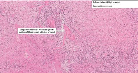 Spleen Infarct Nus Pathweb Nus Pathweb