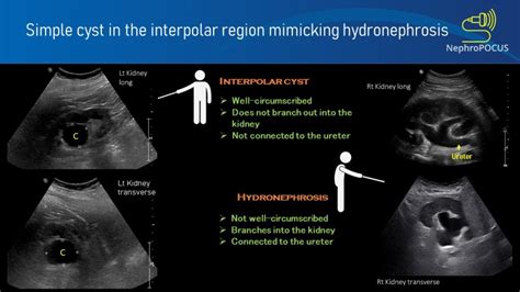 Parapelvic Cyst Mimicking Hydronephrosis Nephropocus