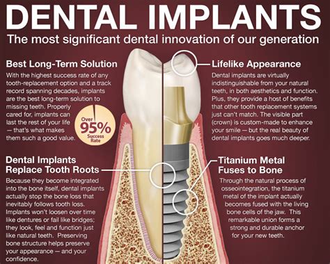 Dental Implants in Kalyan nagar Bangalore | Teeth in an hour