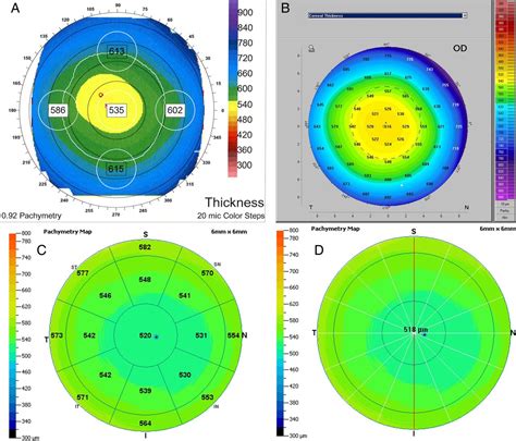 CCT Corneal Thickness Map SRS Eye Hospital 42 OFF