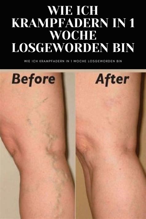 How To Get Rid Of Spider Veins Naturally In 2 Weeks Artofit