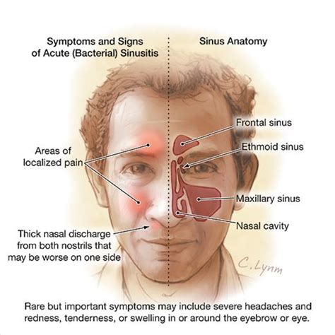 Can A Sinus Infection Cause Throat Pain