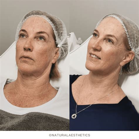 Fractional Rf Skin Resurfacing Improve Skin Texture Scars