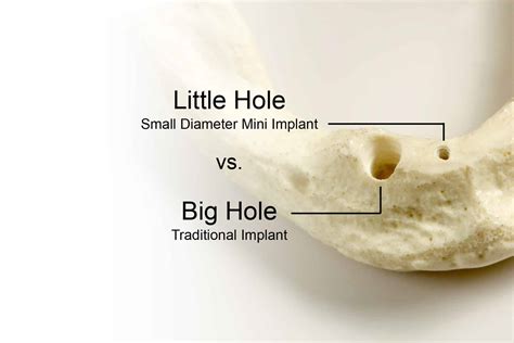 One Piece Implants Redefining Mini In Dental Implants