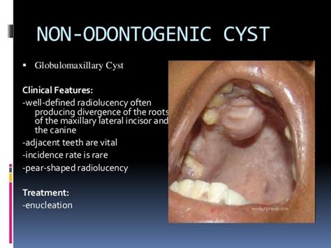 Cysts Of The Oral Cavity