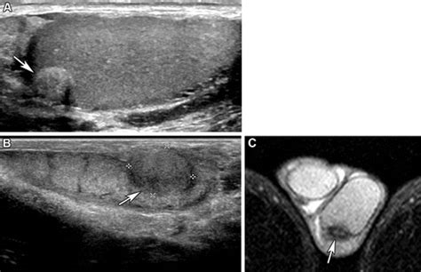 Mesotheliomas And Benign Mesothelial Tumors Update On Pathologic And