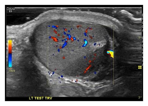 Testicular Ultrasound Showing Hypoechoic Lesion In Left Testis