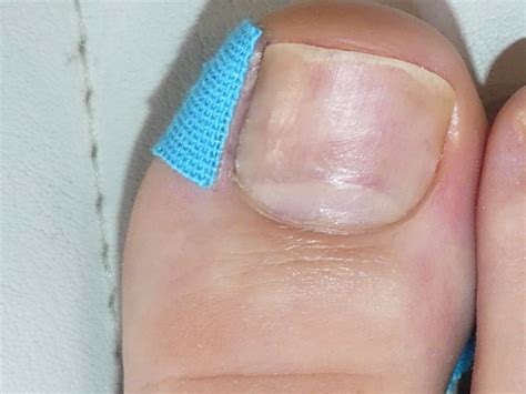 Nagelprobleme Fusspflegeblog