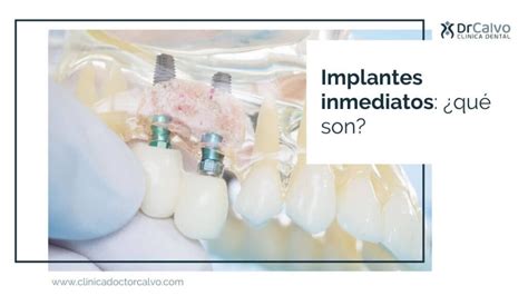 Implantes Con Carga Inmediata Qu Son Cl Nica Doctor Calvo Sevilla