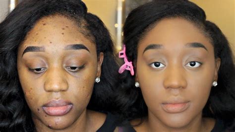 Full Coverage Foundation Routine How To Conceal Acne Scars 2016