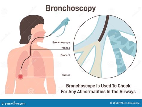 Bronchoscopy Respiratory System Emphysema Endoscopy Human Lung