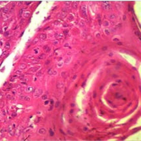 Photomicrograph Showing Well Differentiated Squamous Cell Carcinoma