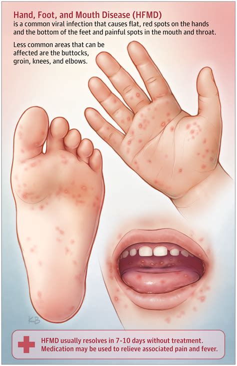 HFMD THE SYMPTOMS OF HFMD Hand Foot And Mouth Disease