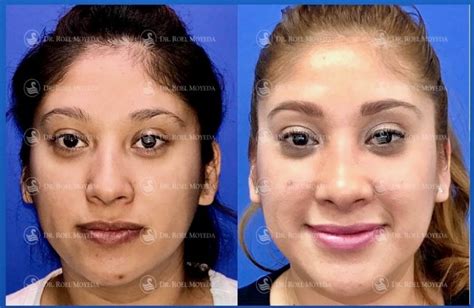 Rinoplastia Caso Rinoplastia Sin Taponamiento Mas D Ti Facial