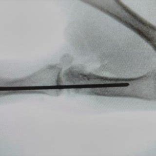 Intraoperative fluoroscopic picture showing reduced first MCP joint ...