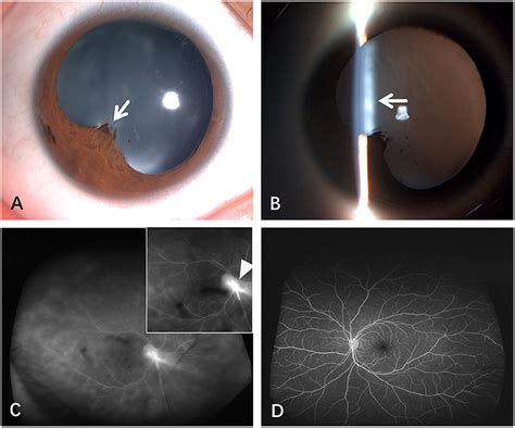 Toxocara Canis Retina