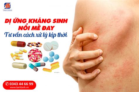 Dị Ứng Thuốc Kháng Sinh Nổi Mề Đay Hiểu Rõ Và Xử Lý Kịp Thời