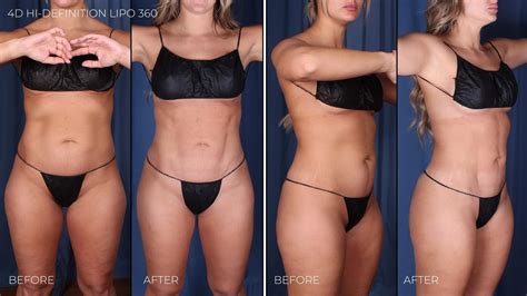 4d Hi Definition Lipo Omaha Liposuction By Imagen