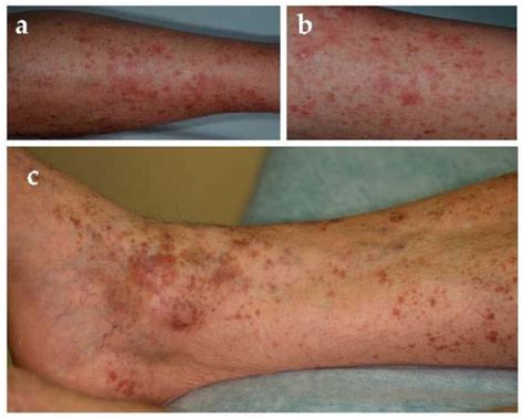 JCM Free Full Text Pigmented Purpuric Dermatoses A Complete