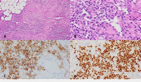 Lymph node biopsy. Lymph node biopsy showing extensive non-necrotizing ...