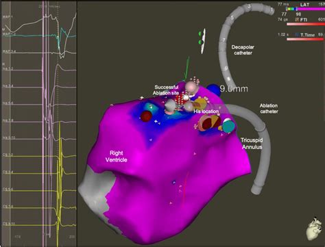 D Electro Anatomical Activation Map Of A Para Hisian Accessory Pathway