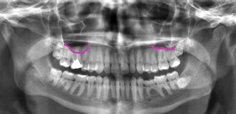 Tooth Pain and Sinuses: Can A Sinus Infection Cause a Toothache? | Oral ...