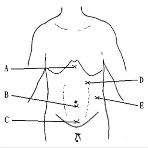 Outcomes Of Laparoscopic Splenectomy LS Versus Open Splenectomy OS